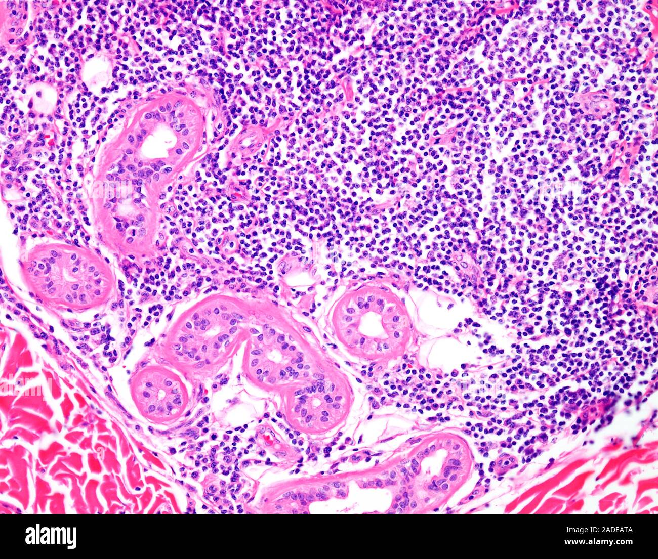 Small Lymphocytic Lymphoma, Light Micrograph. B-cell Chronic ...