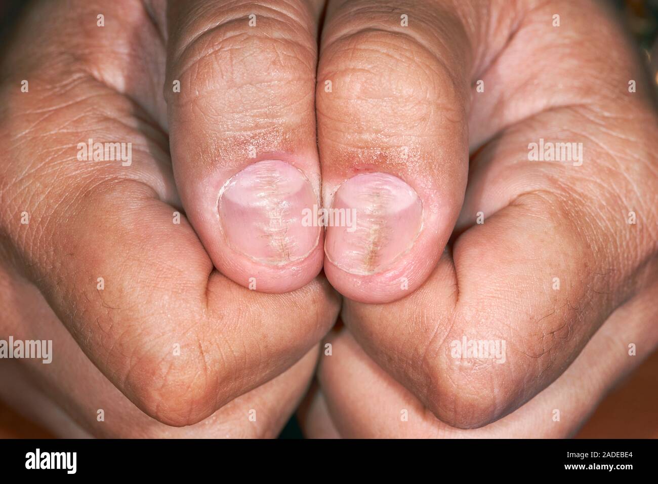 Median Dystrophy of Heller affecting both great thumb nails. | Download  Scientific Diagram