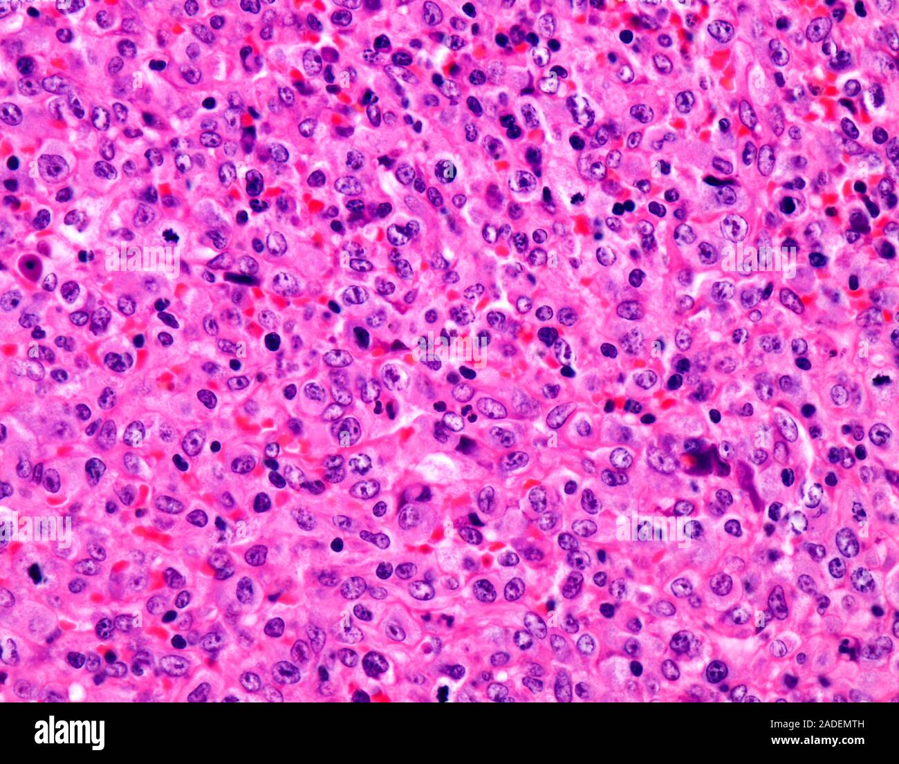 Peripheral T-cell lymphoma, light micrograph. In peripheral T-cell ...