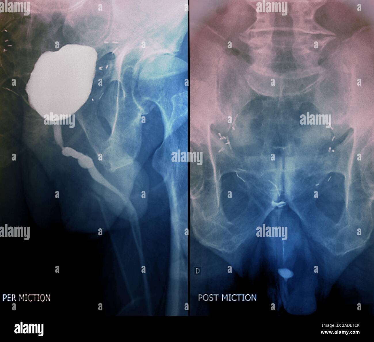 Bladder after prostate removal. Coloured Xrays of a section through