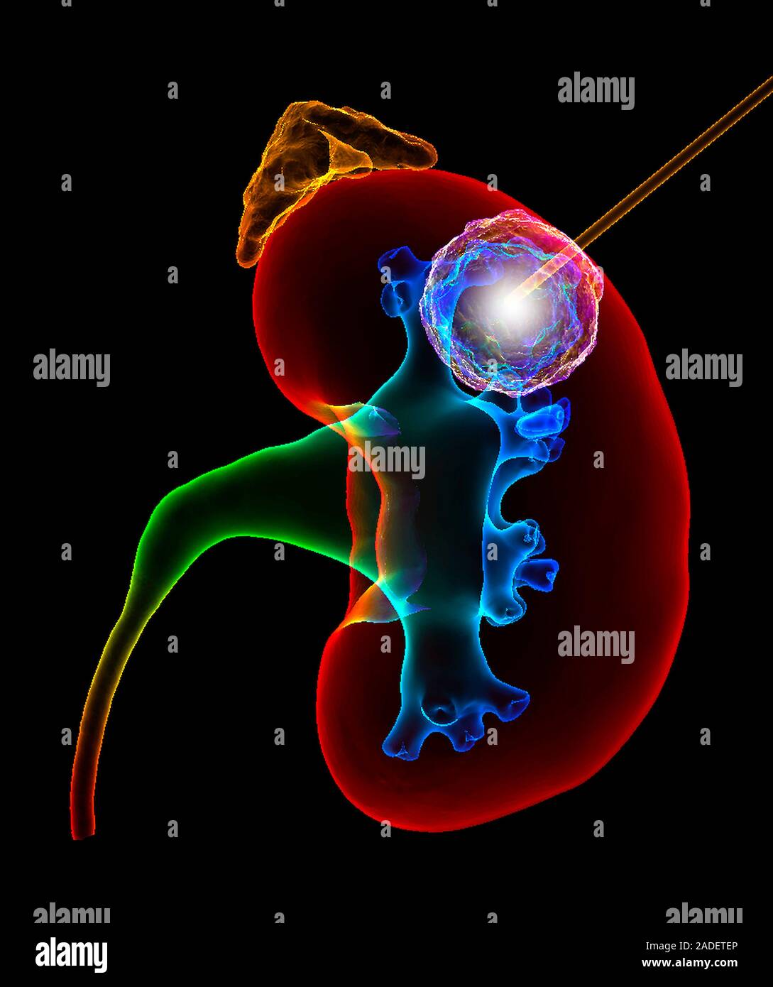 Kidney cancer thermal ablation. Illustration of radiofrequency or