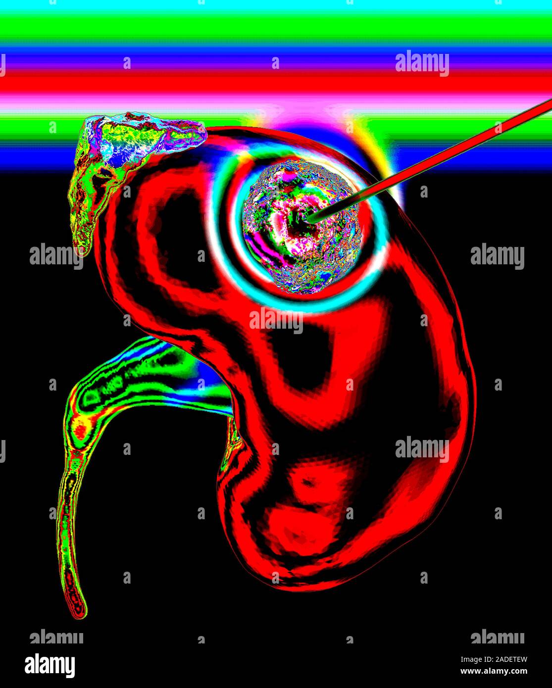 Kidney cancer thermal ablation. Popart style illustration of