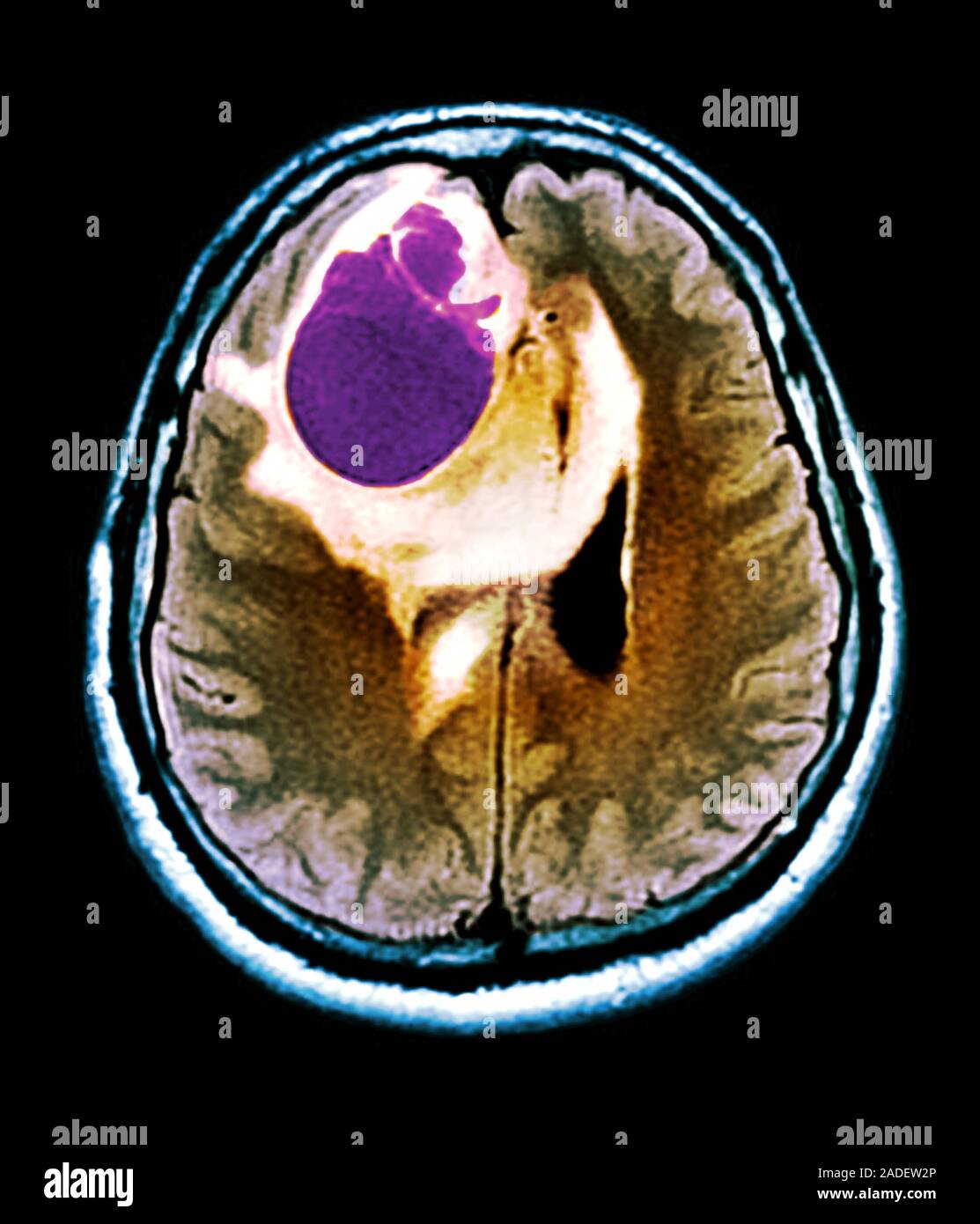 Brain tumour. Coloured magnetic resonance imaging (MRI) scan of an ...