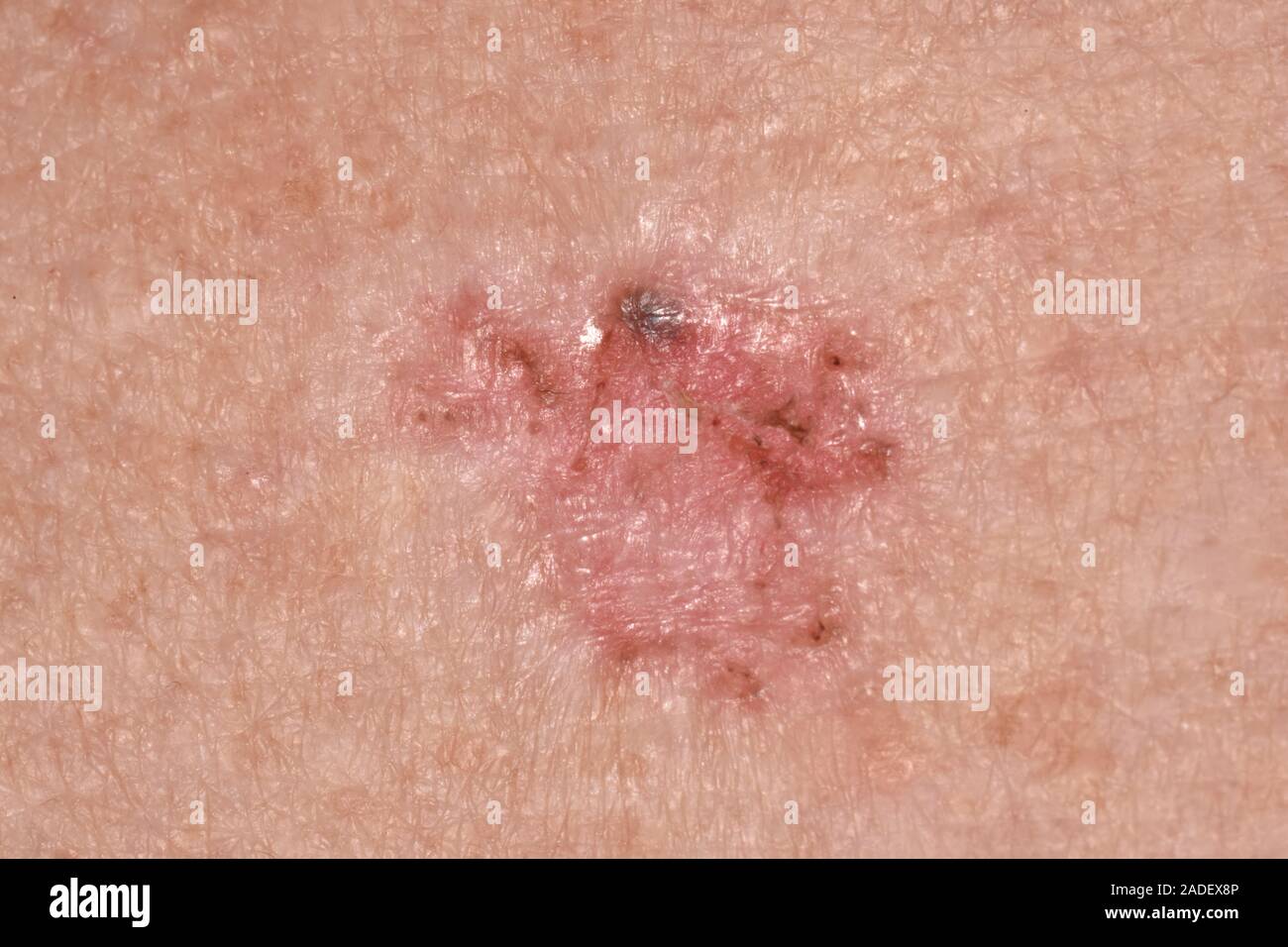 MODEL RELEASED. Basal cell carcinoma on the skin of a 75yearold man