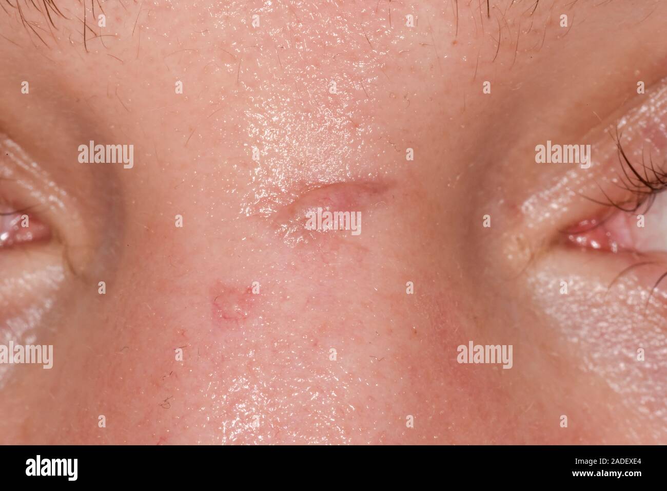 MODEL RELEASED. Keloid scarring on the bridge of the nose of a 26year