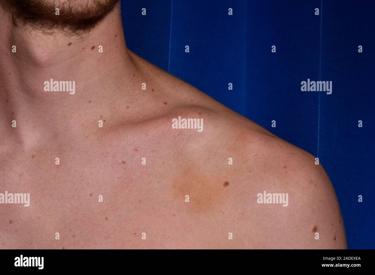 MODEL RELEASED. Collar bone fracture. 21yearold man with a fractured