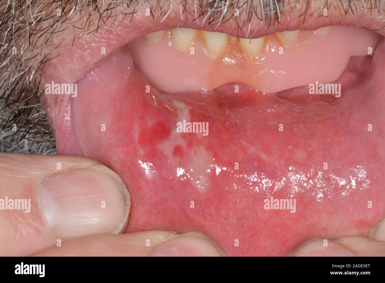 MODEL RELEASED. Mouth ulcer inside lower lip in a 67yearold man. This