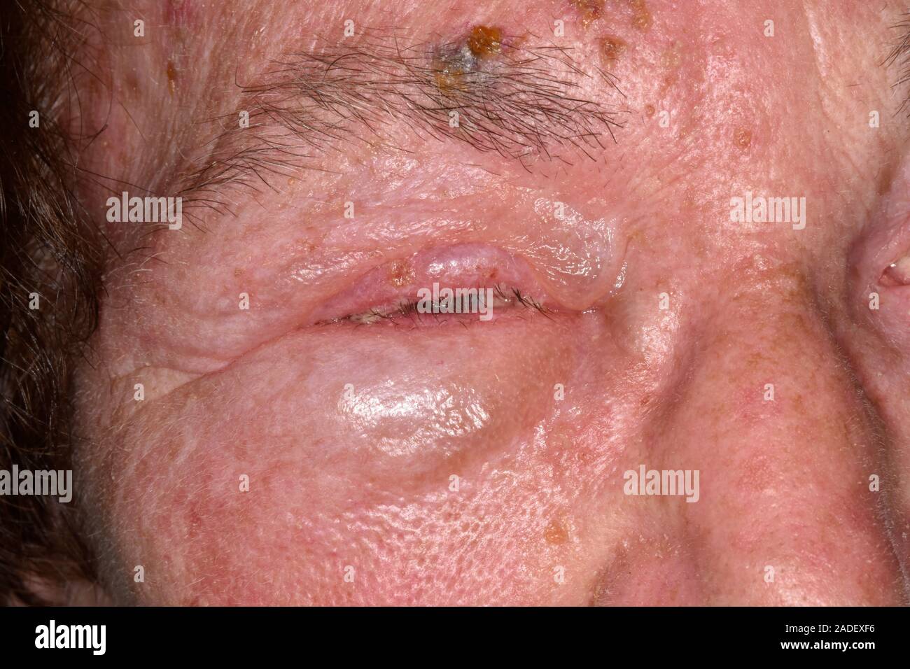MODEL RELEASED. Shingles rash affecting facial nerve. Shingles rash
