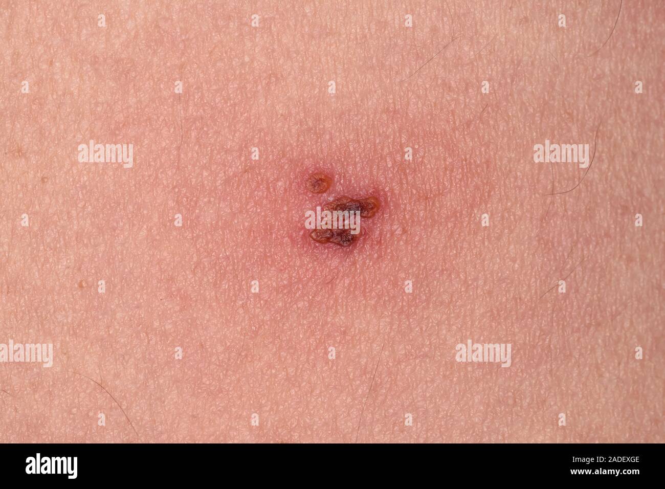 MODEL RELEASED. Healing shingles rash and lesions on the skin of a 65 ...