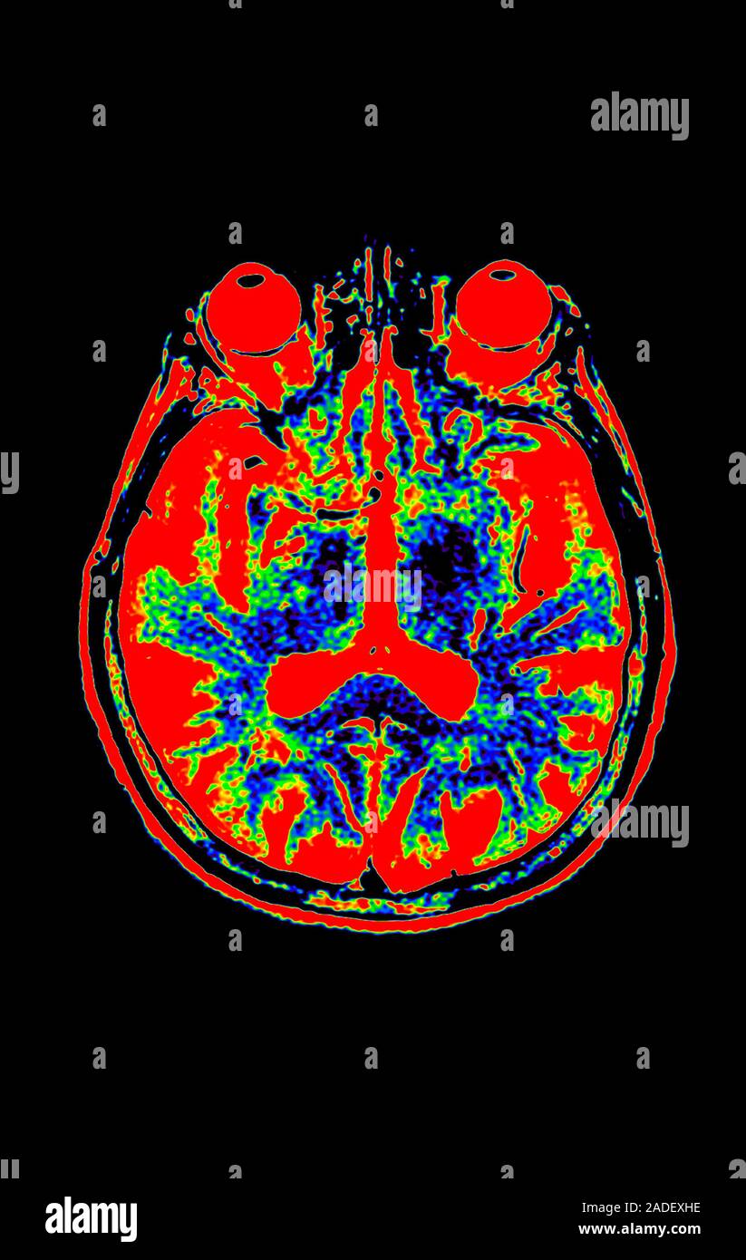 Human eyes and brain. Coloured axial magnetic resonance imaging (MRI ...