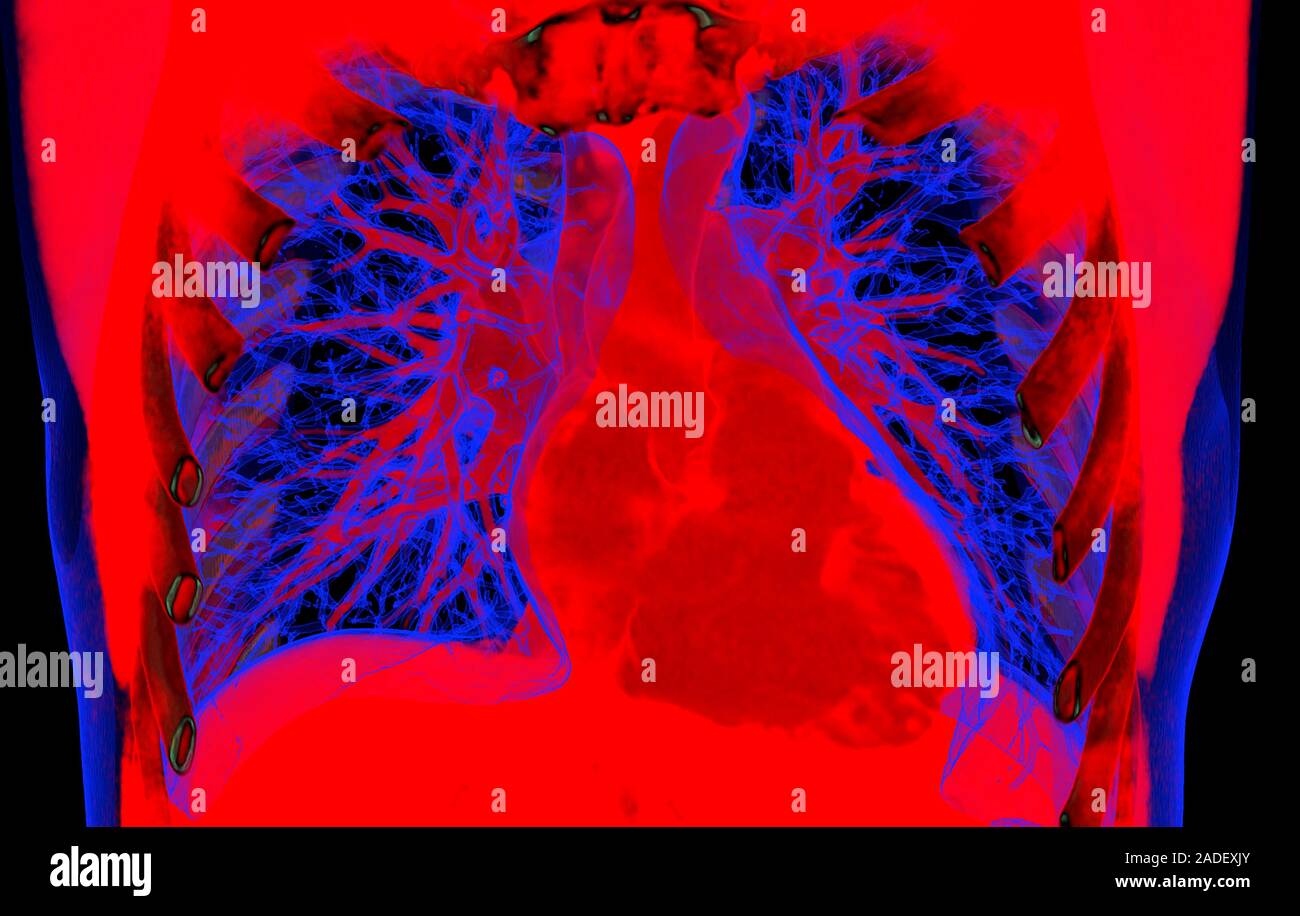 Heart and lungs, 3D coloured computed tomography (CT) scan. The heart