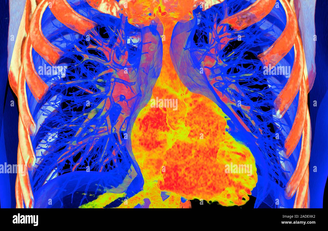 Heart and lungs, 3D coloured computed tomography (CT) scan. The heart