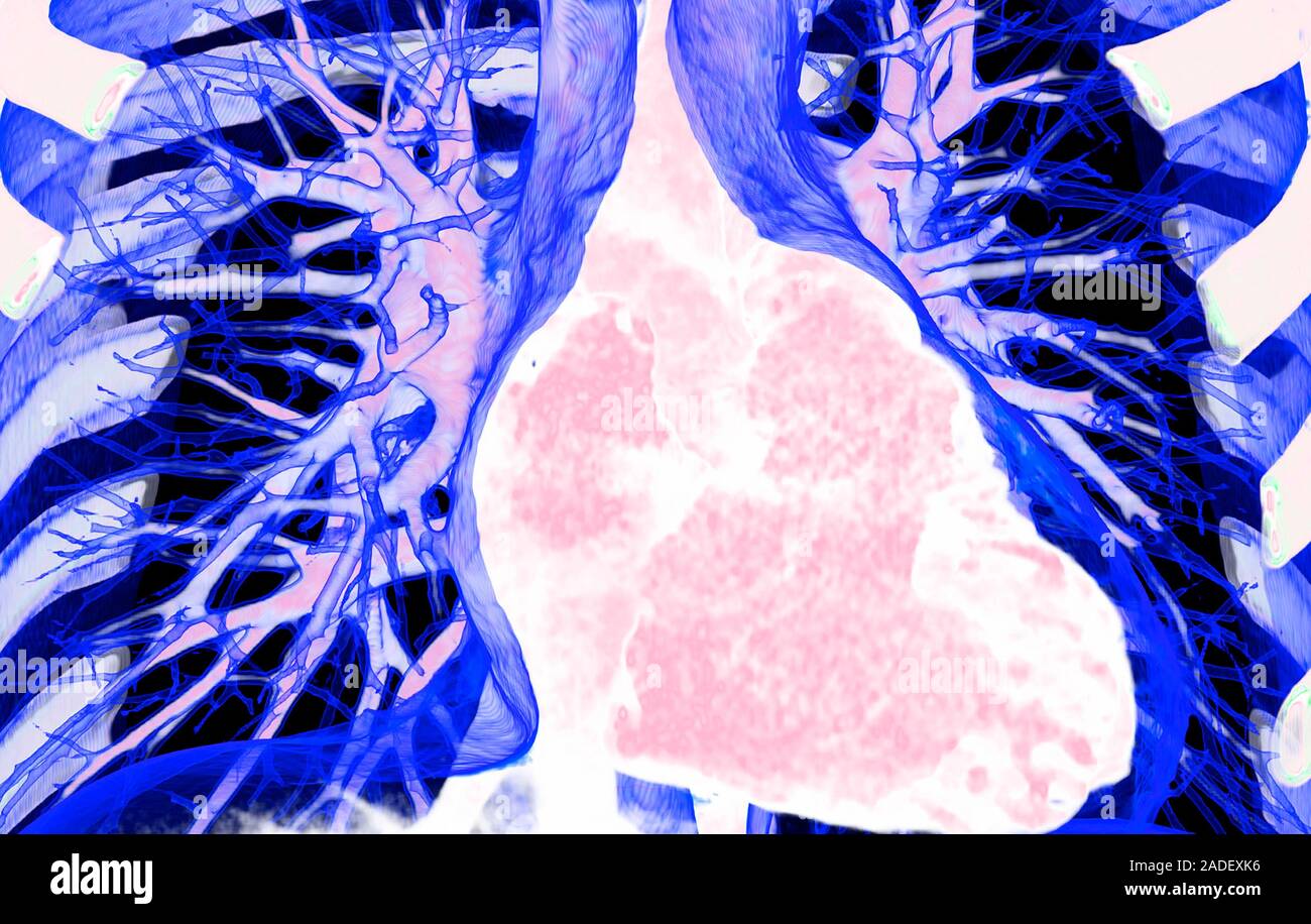 Heart and lungs, 3D coloured computed tomography (CT) scan. The heart