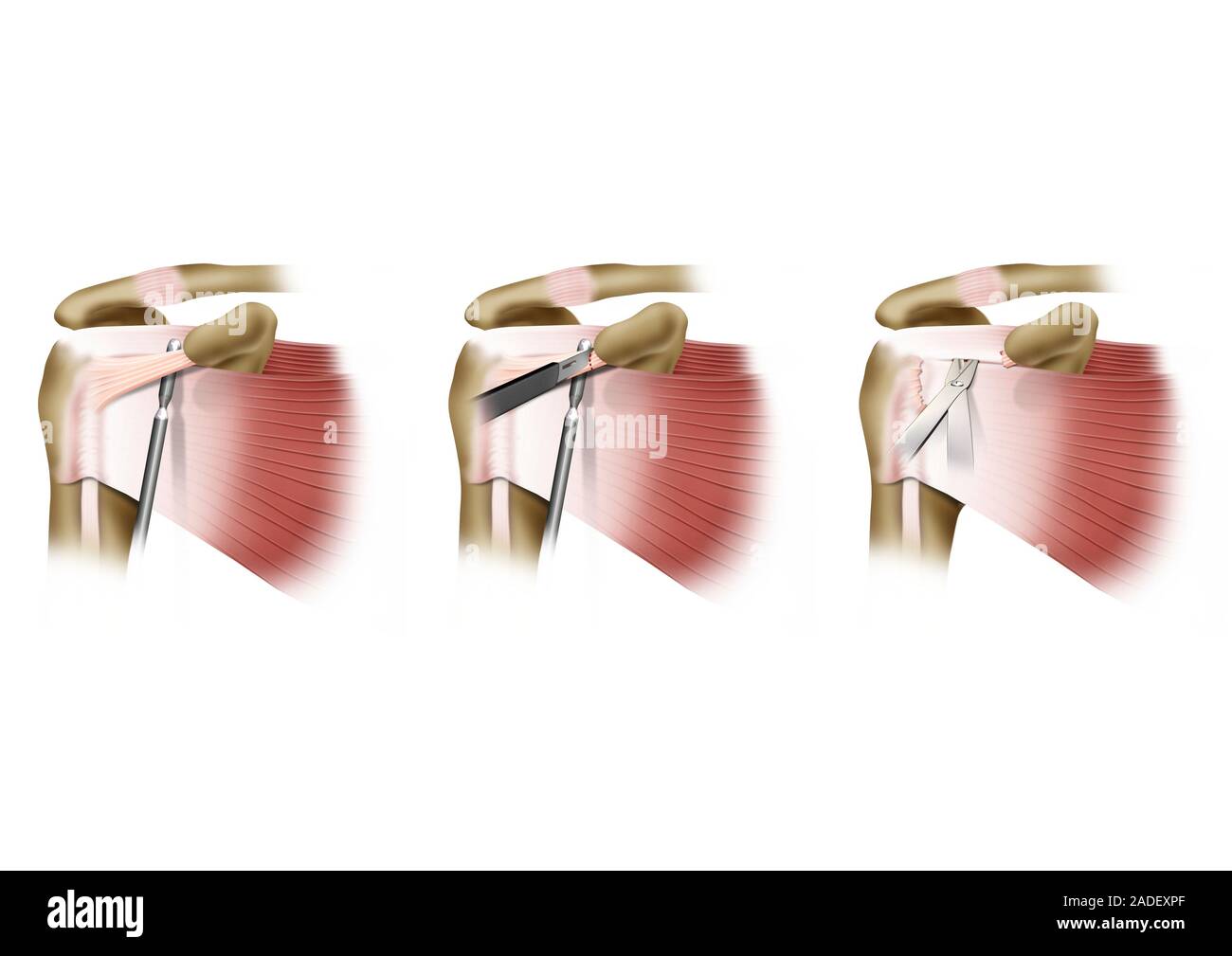 Adhesive capsulitis shoulder surgery, illustration. Adhesive capsulitis