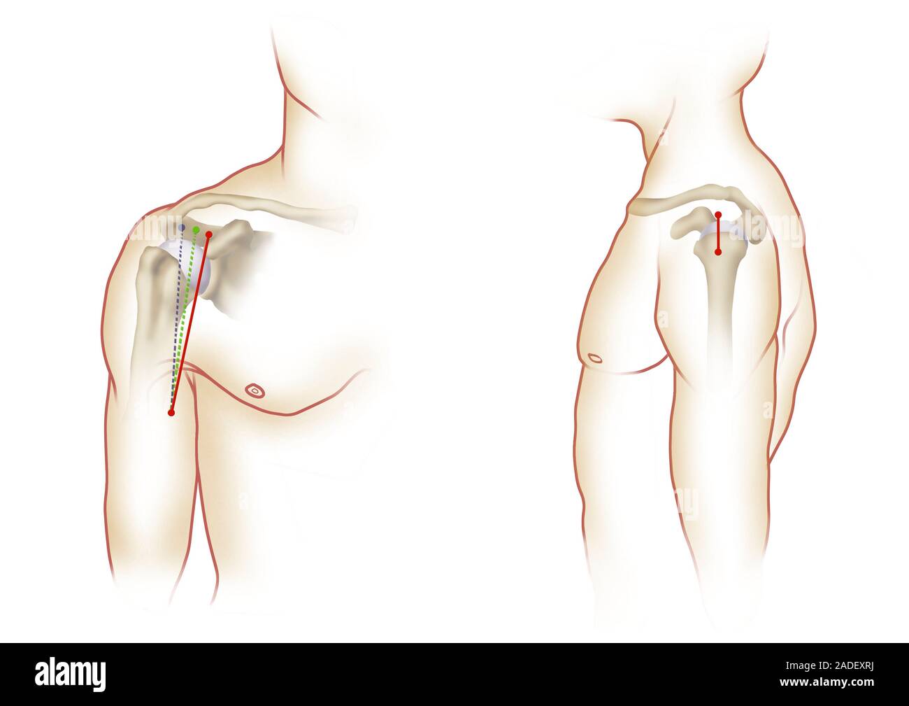 Deltoid muscle shoulder anatomy, illustration. The deltoid muscle is a ...