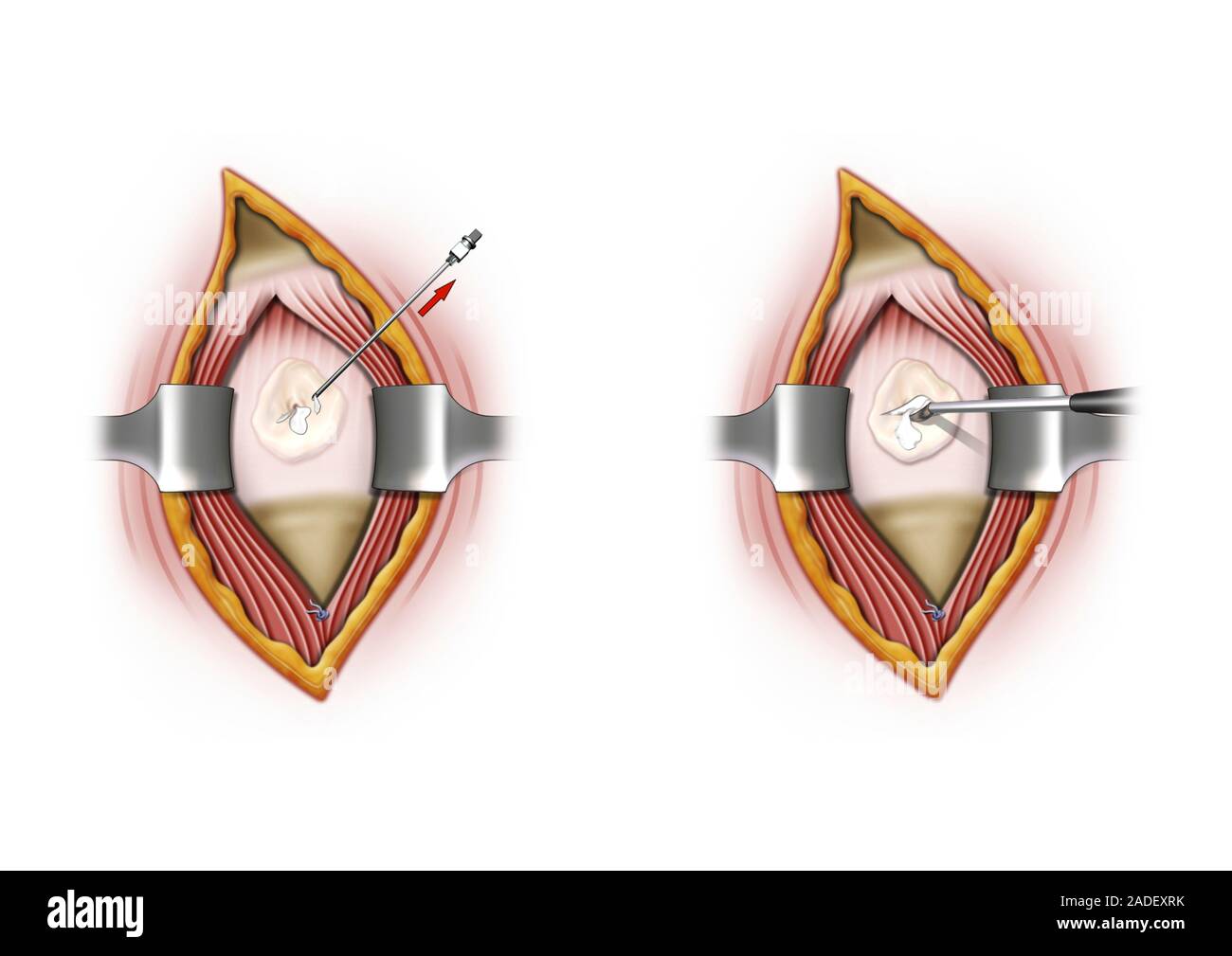 Joint calcification shoulder surgery, illustration. This condition is