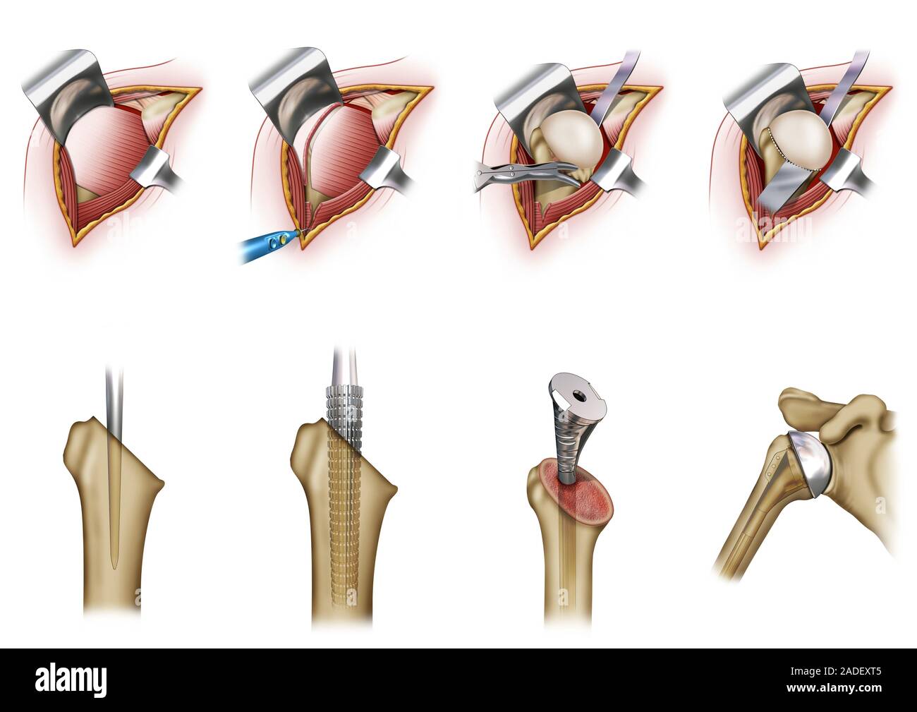 Humeral prosthesis shoulder surgery, illustration. This operation is