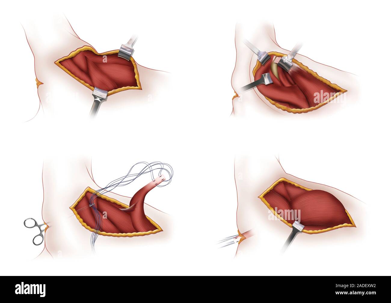 Muscle Operation Shoulder muscles surgery, illustration. The muscles being operated on ...