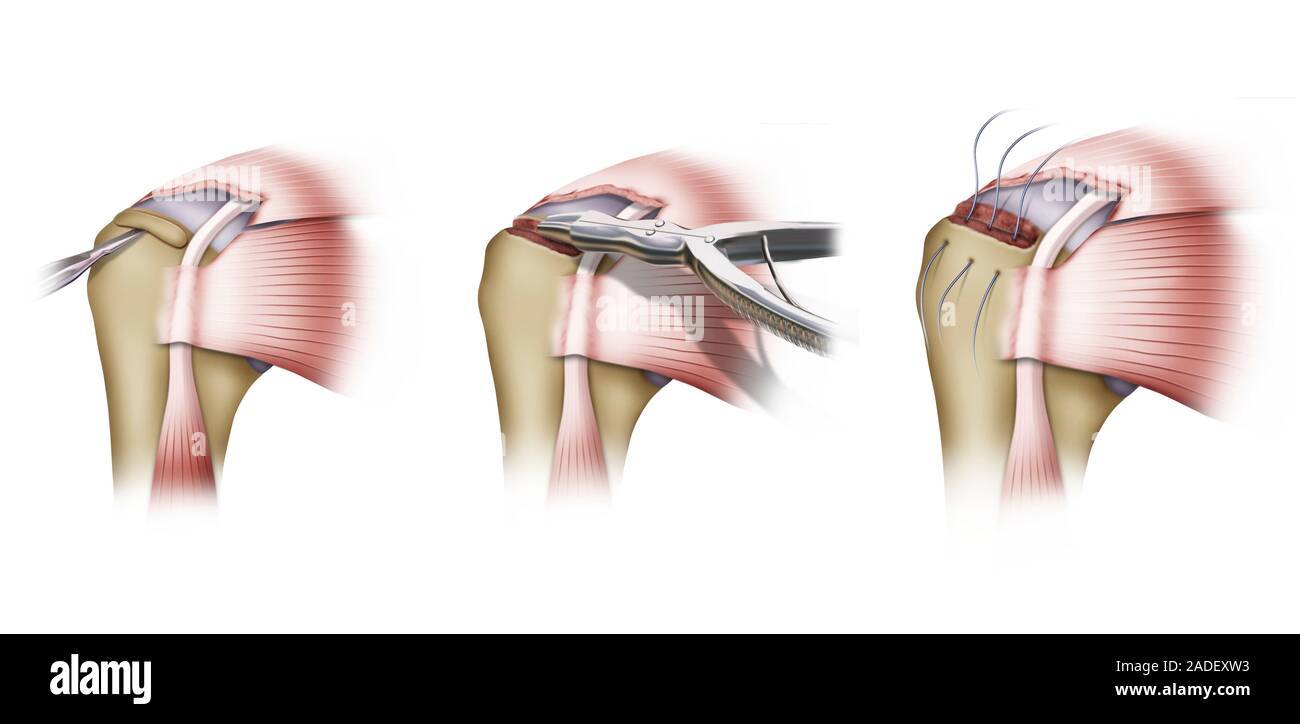 Muscle Operation Shoulder muscles surgery, illustration. The muscle being operated on ...