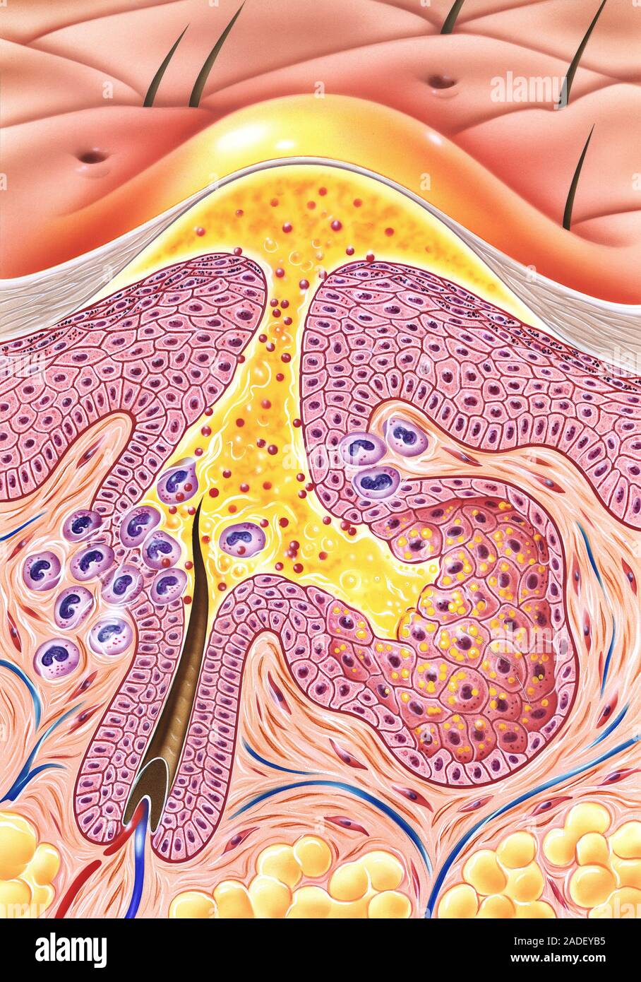 Skin Pustule Model Acne. Illustration of a section through the skin showing a pustule (pus ...