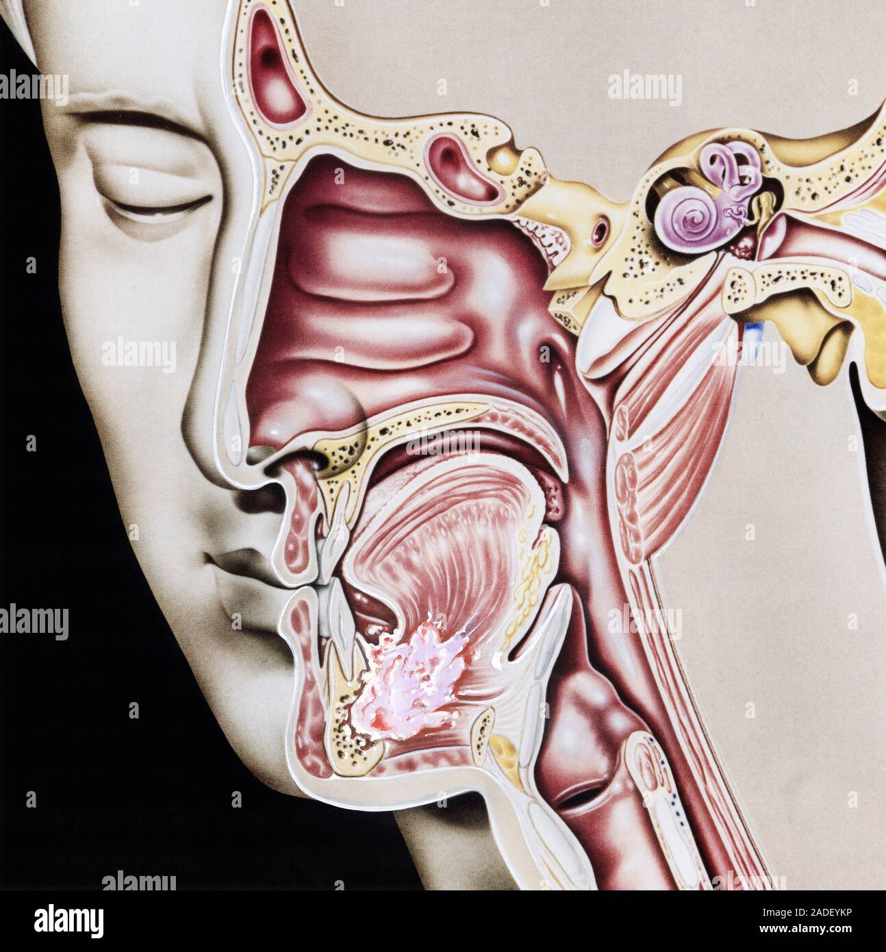 Floor of the mouth cancer. Cutaway illustration showing a carcinoma as ...