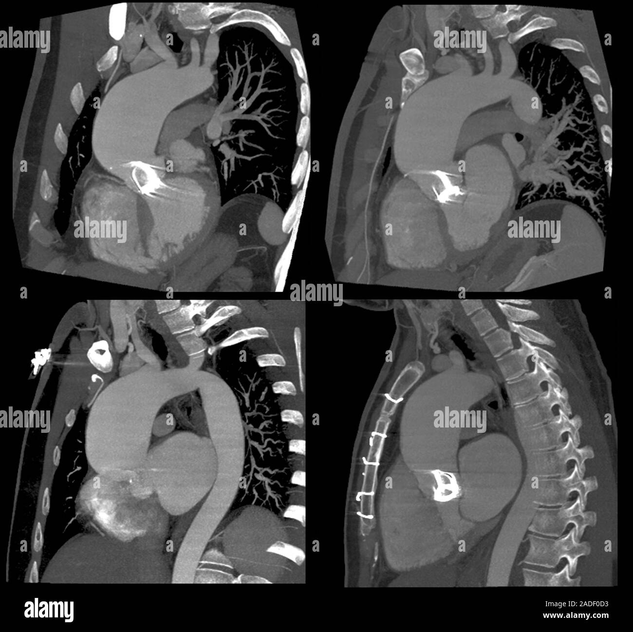 thoracic aortic aneurysm xray