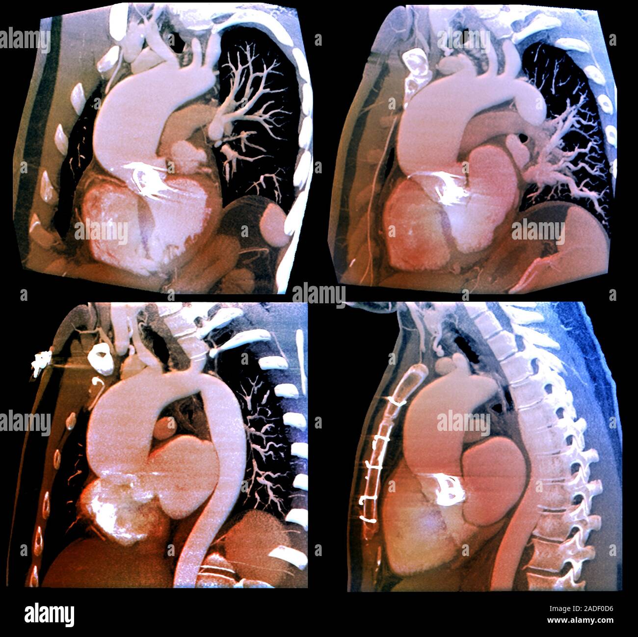 Thoracic aortic aneurysm. Coloured computed tomography angiogram (CTA ...