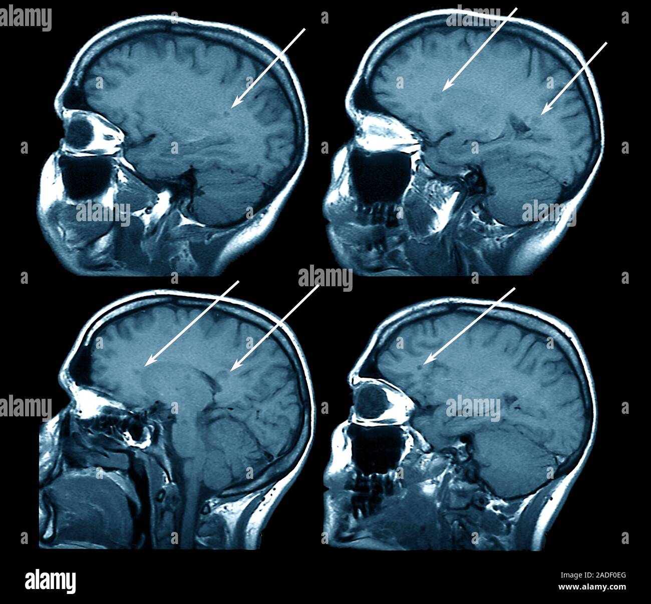 neurontin para la esclerosis multiple