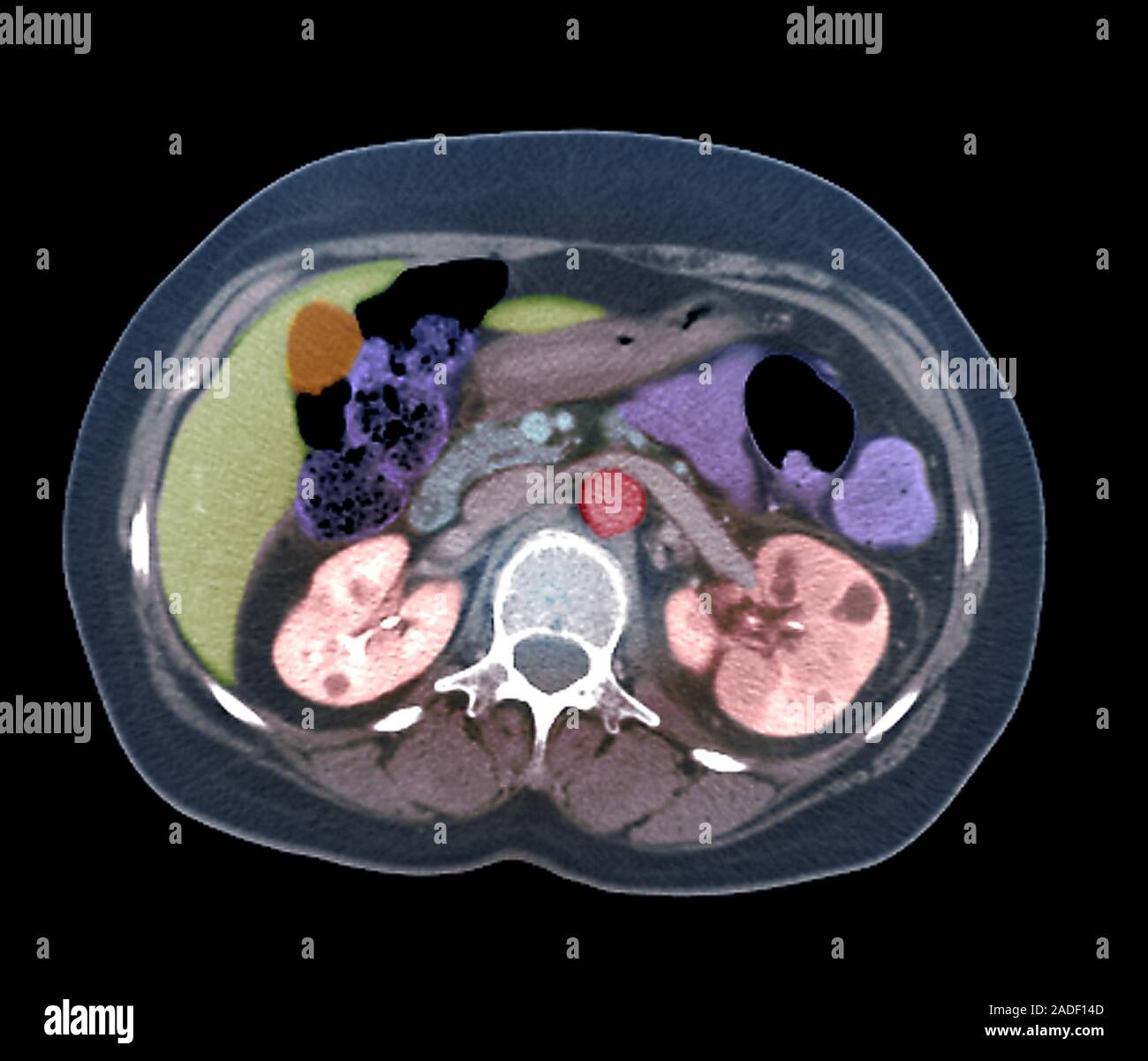 Pyelonephritis. Coloured axial computed tomography (CT) scan through ...