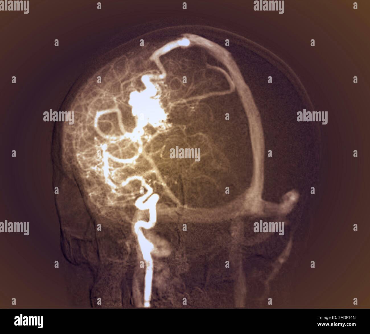 Cerebral arteriovenous malformation. Threequarter posterior Xray of the skull and brain of a