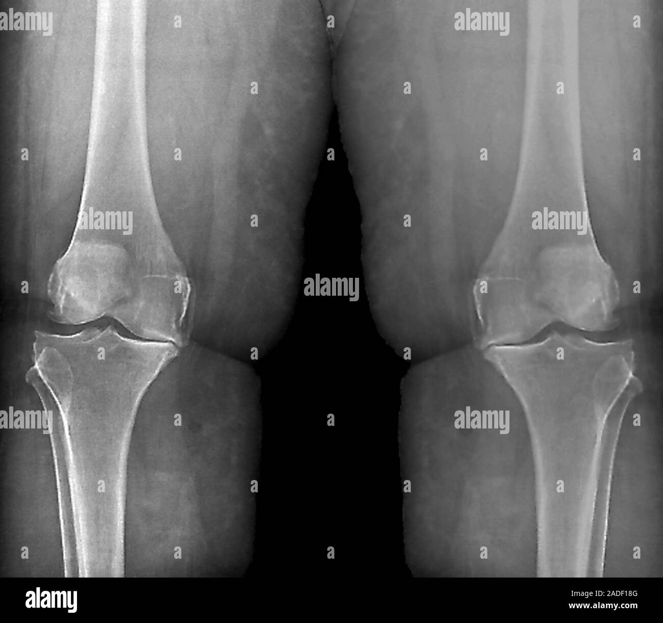 Knee osteoarthritis in obesity. Frontal X-ray of the knees of a 67-year ...