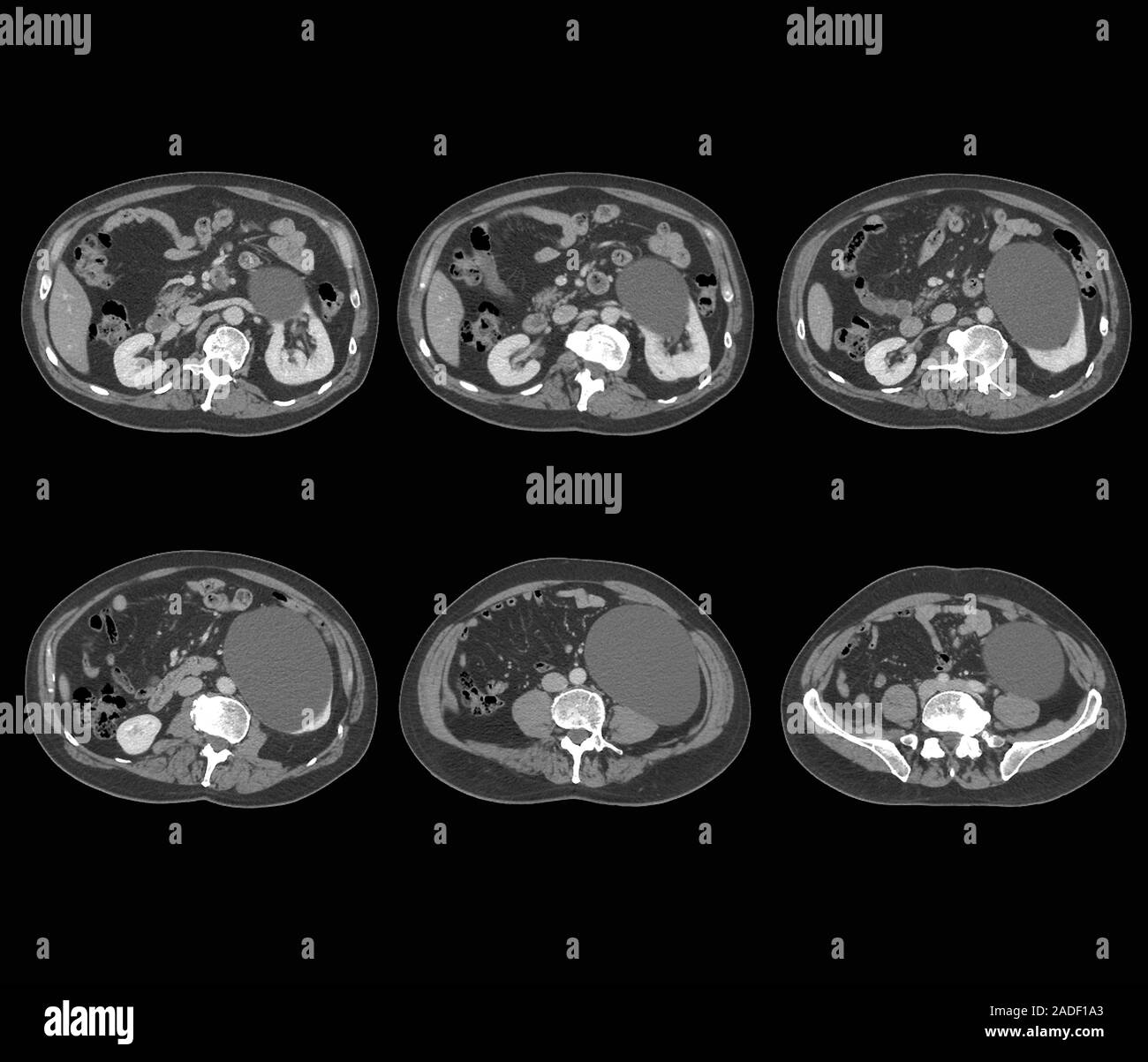 Kidney cyst. Axial computed tomography (CT) scans through the abdomen of a 52-year-old man with a large cyst on his left kidney (at right in each scan Stock Photo