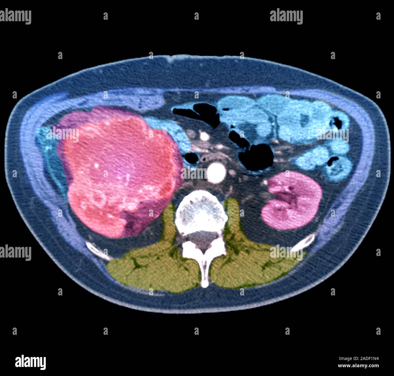 Kidney cancer. Coloured axial computed tomography (CT) scan through the