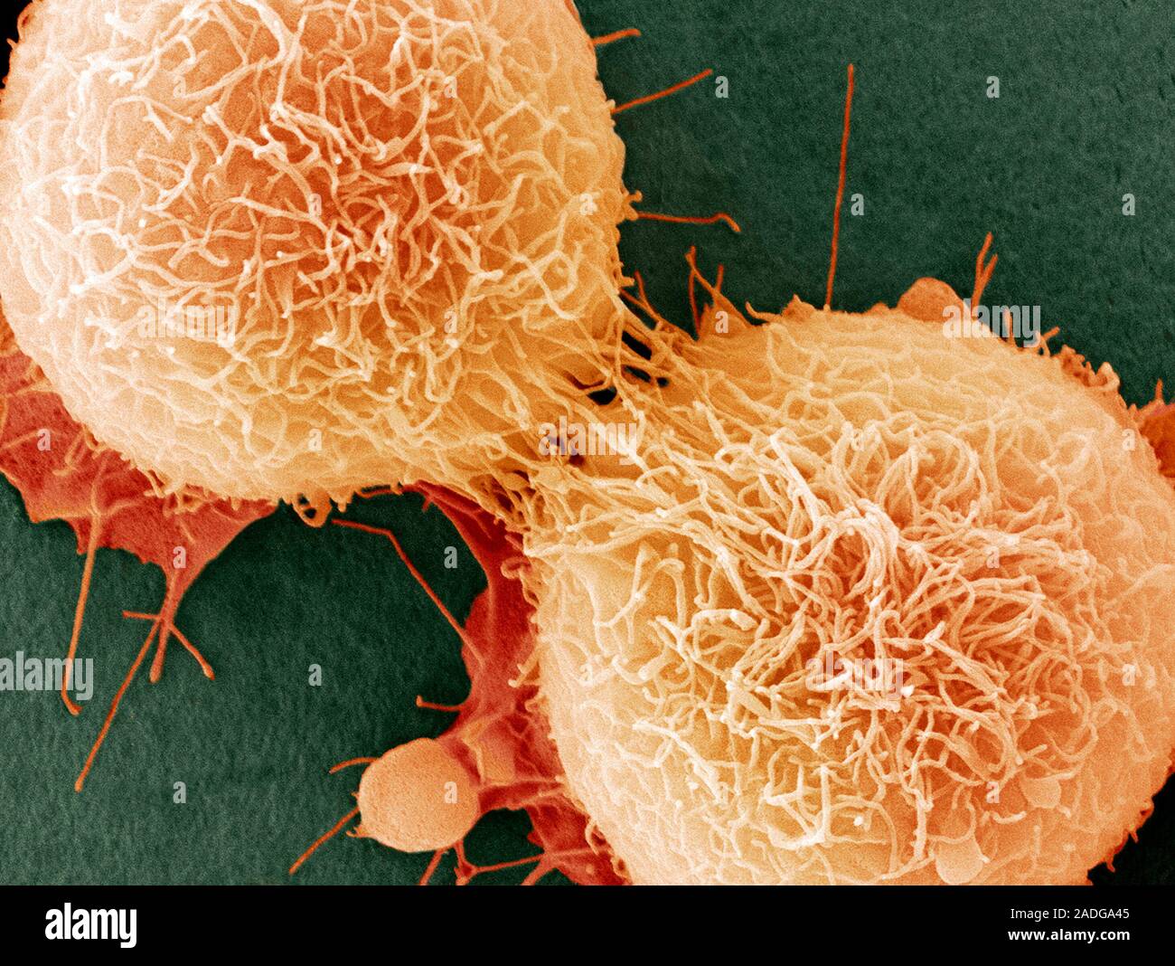 HeLa cells, coloured scanning electron micrograph (SEM). The cells have
