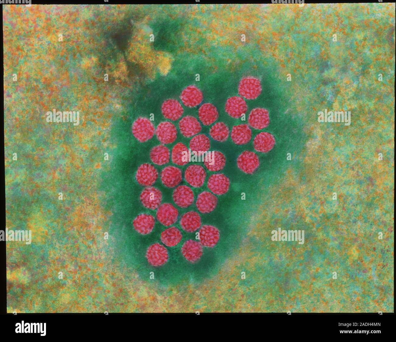 Wart virus. Coloured transmission electron micrograph of Papilloma