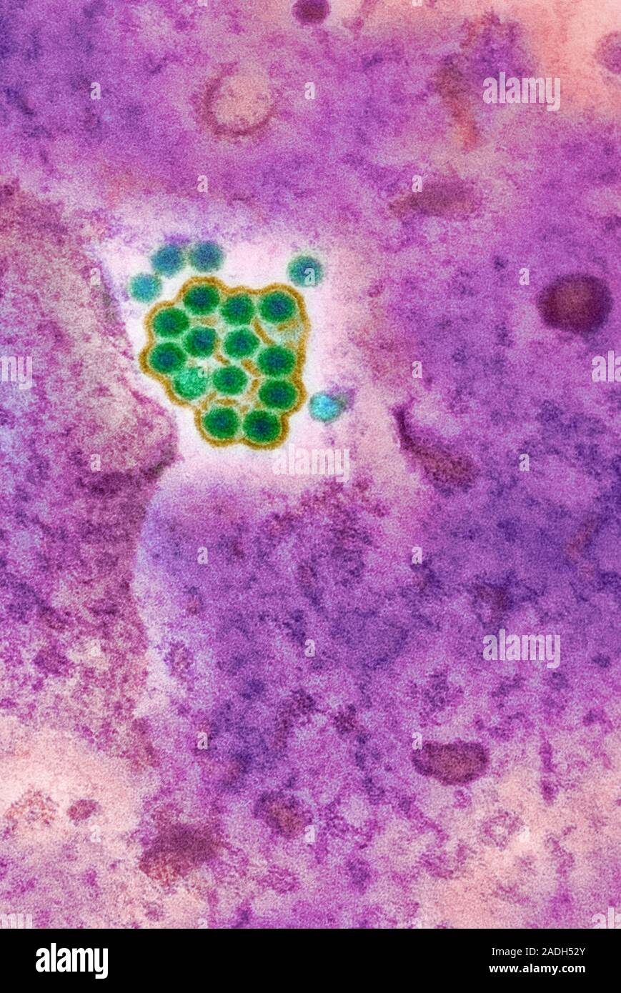 Yellow fever virus particles. Coloured transmission electron micrograph