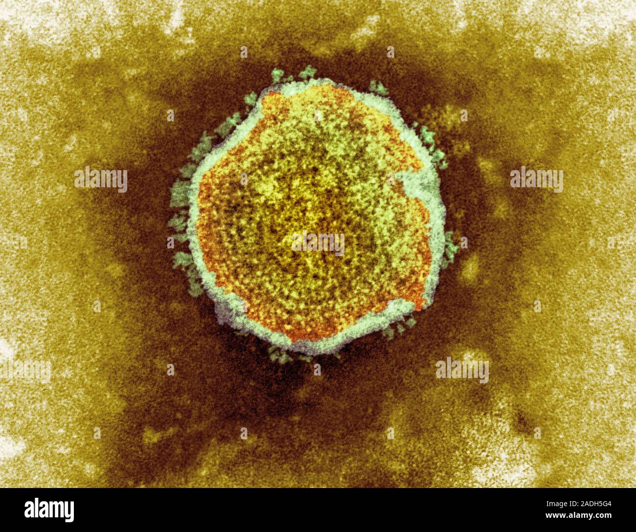 Mumps virus particle, coloured transmission electron micrograph (TEM). A mumps virus particle contains ribonucleic acid (RNA) enclosed in a spherical Stock Photo