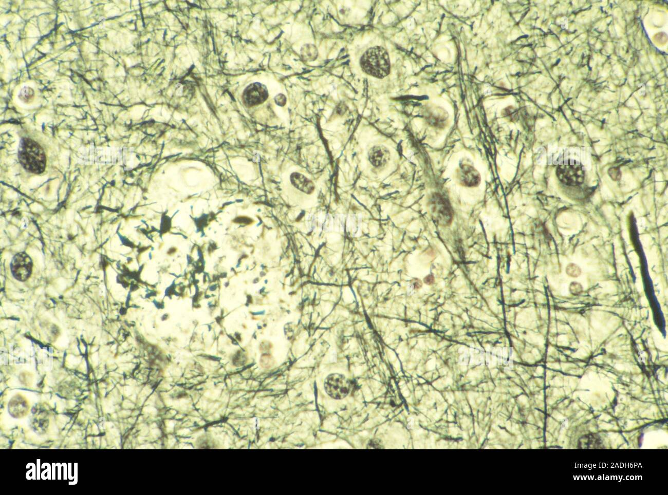 Light micrograph of human brain tissue in Alzheimer's disease, showing a senile plaque (pale
