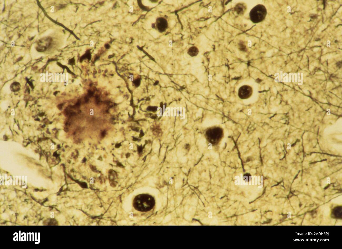 Light micrograph of human brain tissue in Alzheimer's disease, showing a senile plaque (circular
