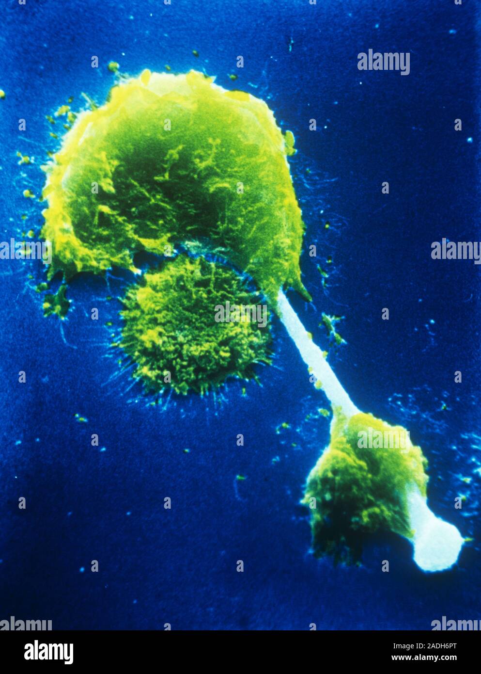 Asbestosis falsecolour scanning electron micrograph (SEM) showing two