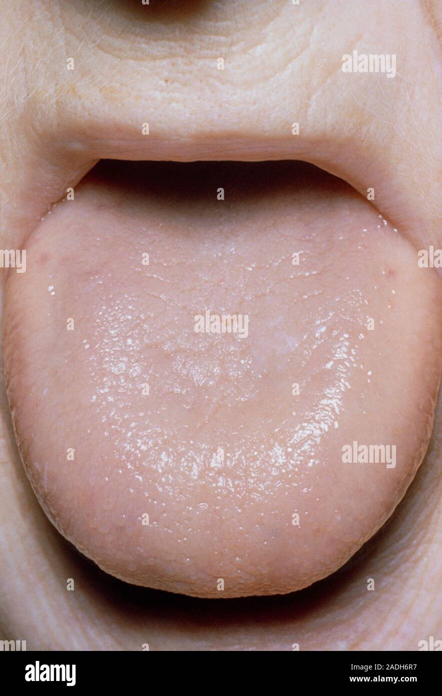 Anemia tongue