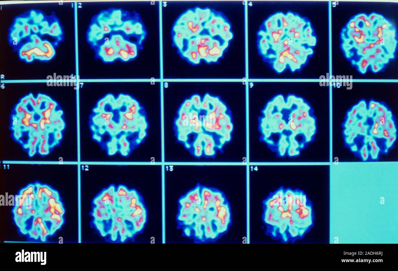 Positron emission tomography (PET) scan series of the brain of a