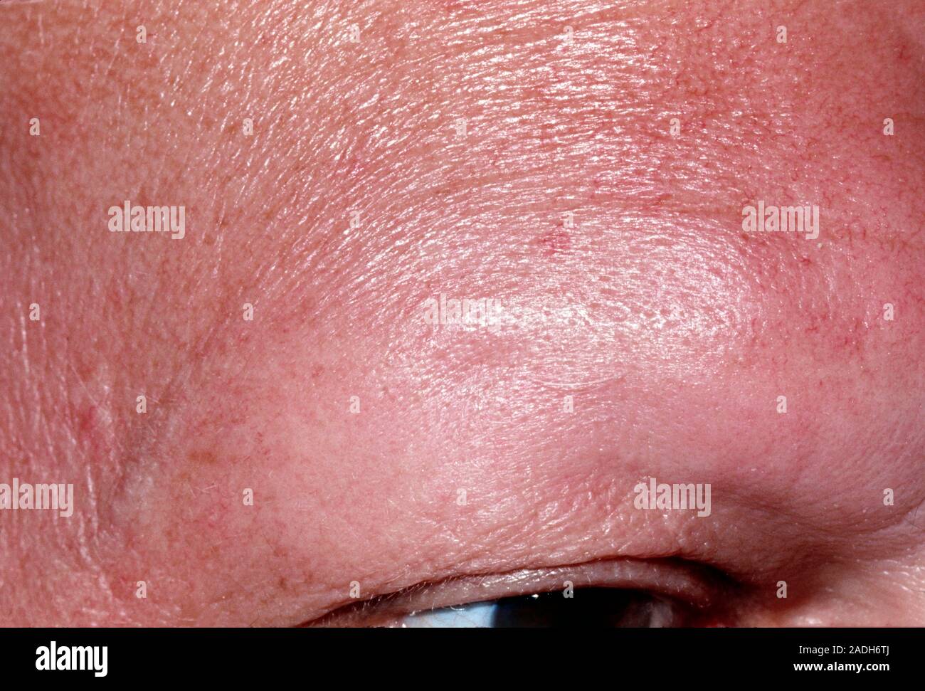 Alopecia Areata hair Loss Of Eyebrow Close up Of Alopecia Areata 