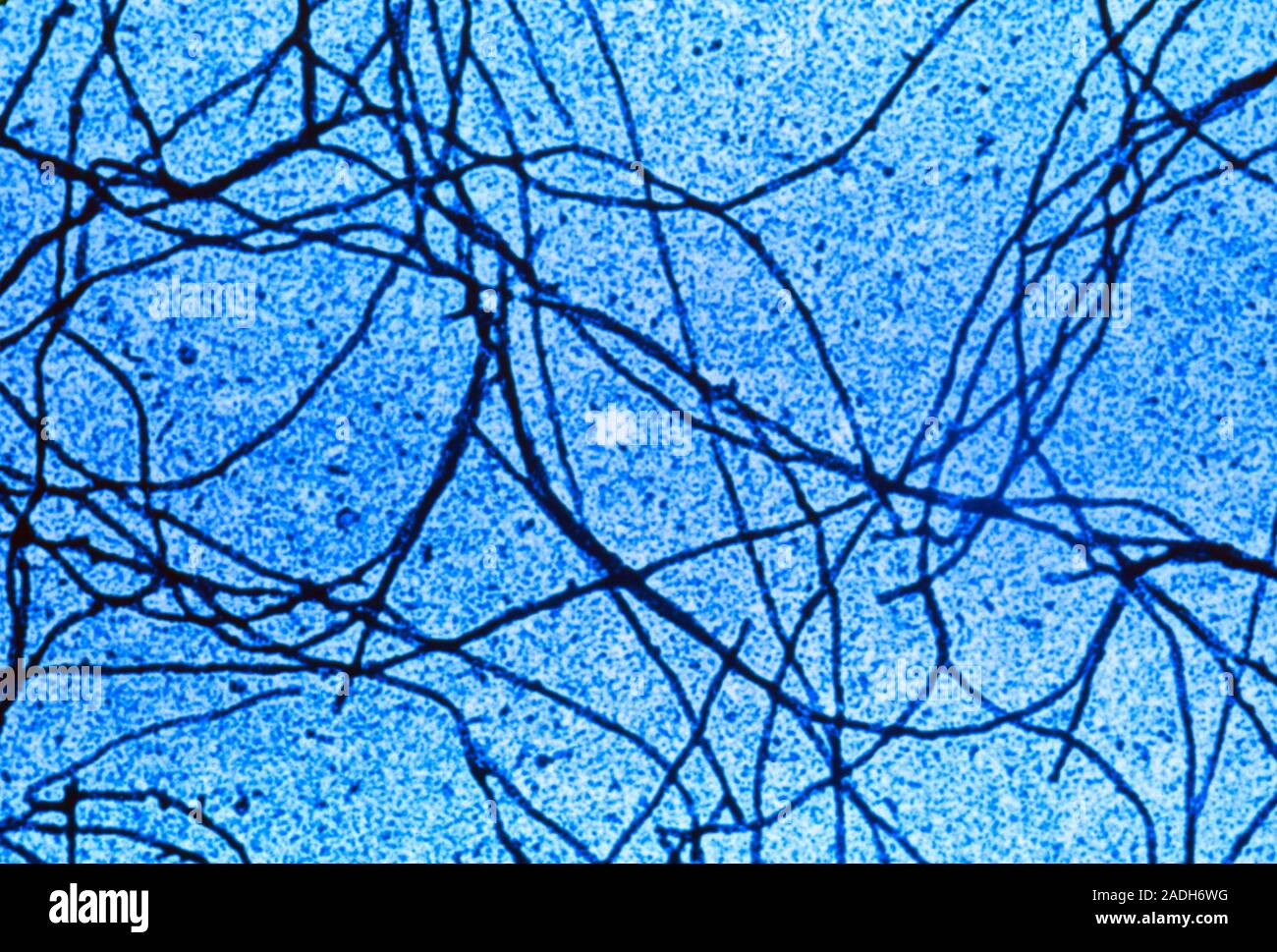 Protein filaments in Alzheimer's disease. Coloured Transmission ...