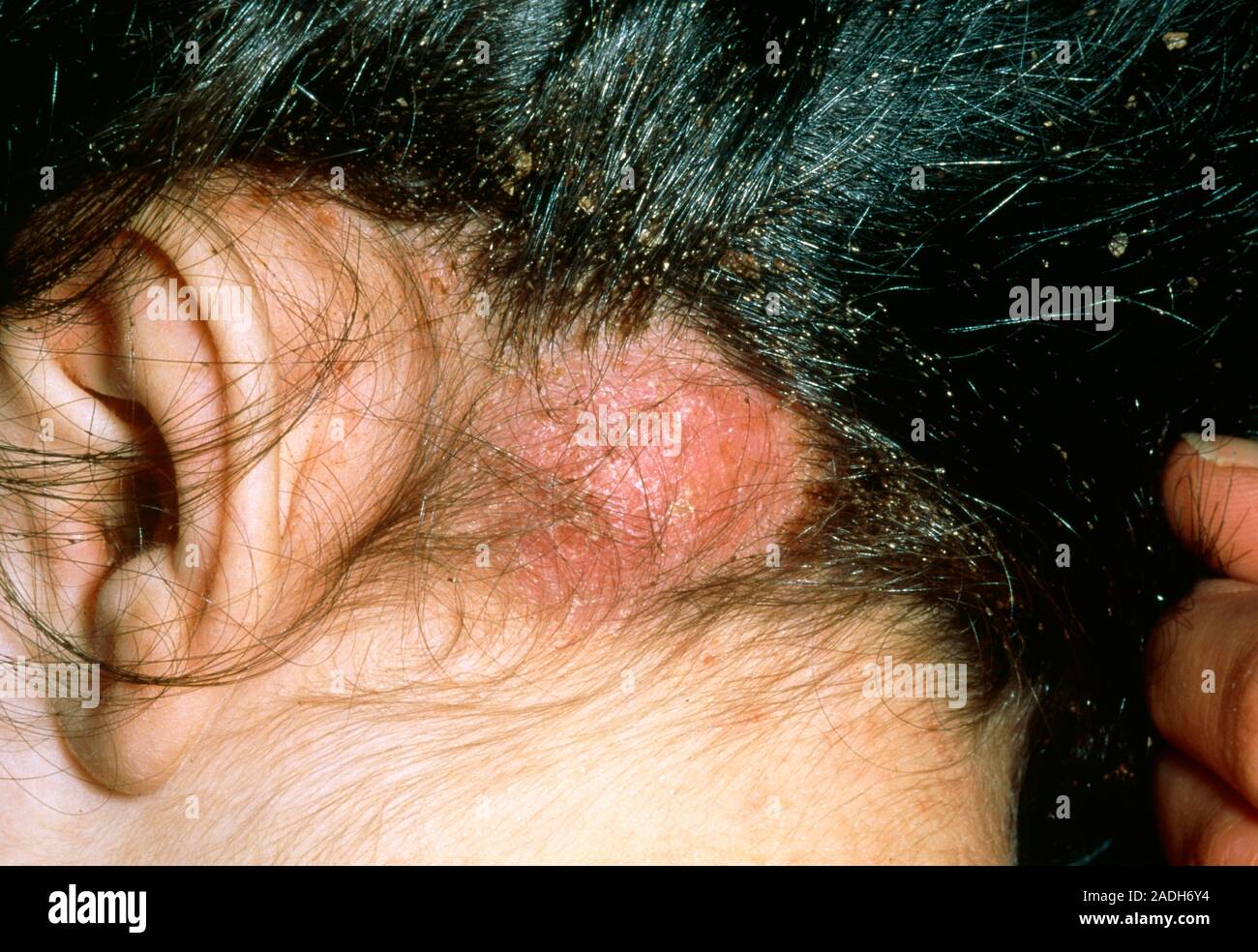 Abscess and head lice. View of an abscess on the scalp of a twoyear