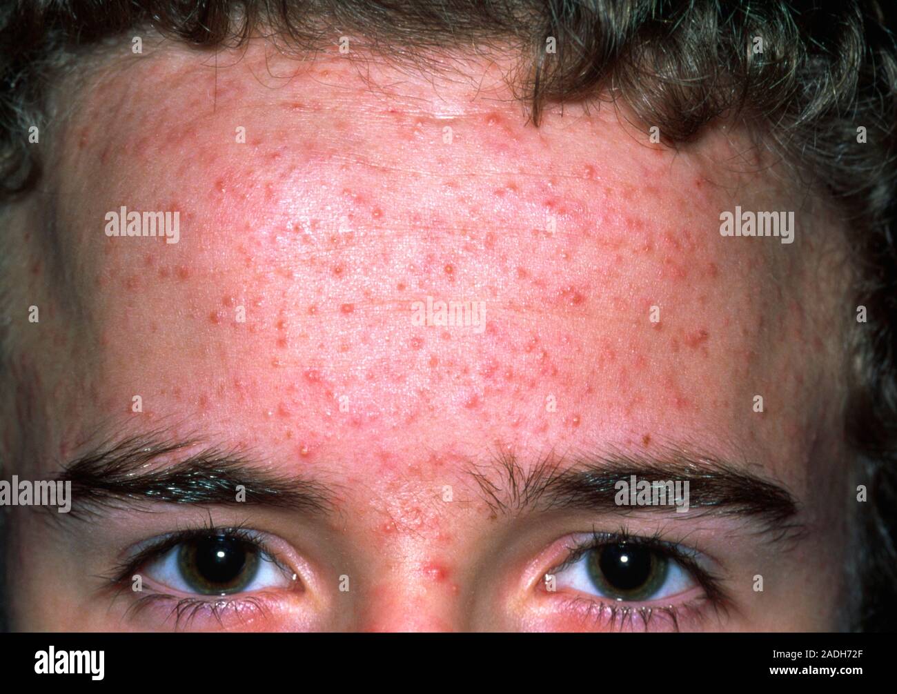 Acne vulgaris. Acne on the skin of a 16 year old boy's forehead. Acne is a general name given to