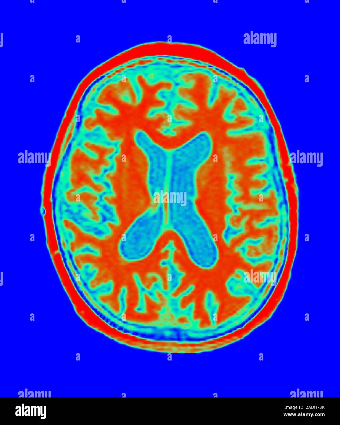 Alzheimer's disease. Coloured magnetic resonance imaging (MRI) scan of ...