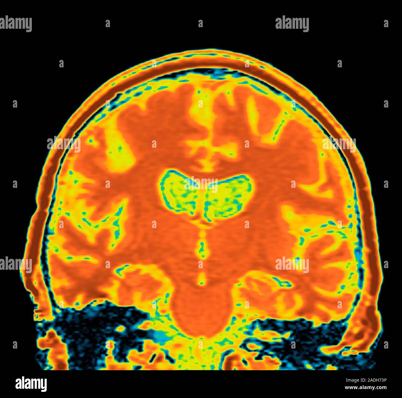 Alzheimer's disease. Coloured resonance imaging (MRI) scan of