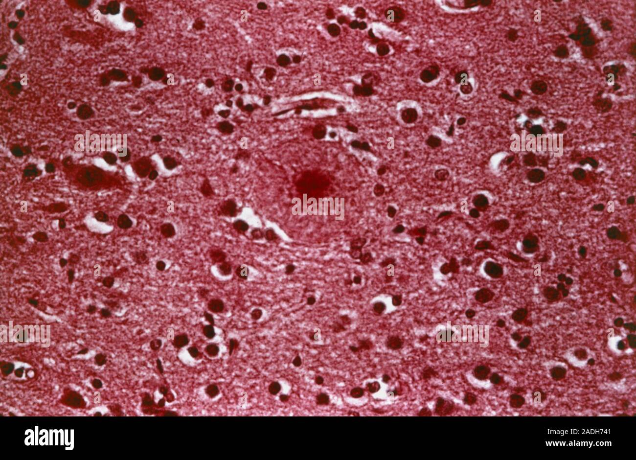 Alzheimer's disease. Light micrograph of a section through the brain of