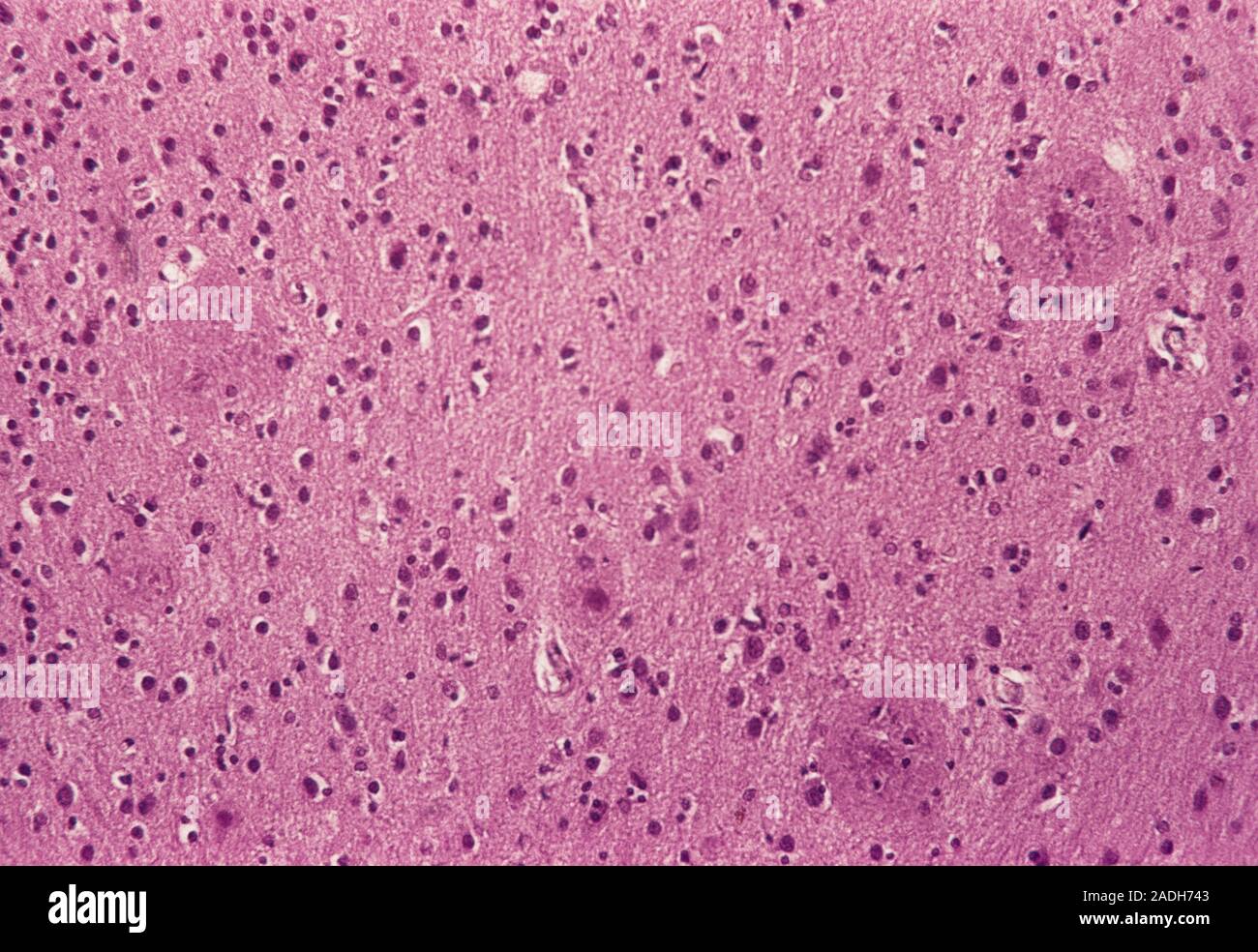 Alzheimer's disease. Light micrograph of a section through the brain of